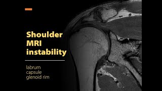 Shoulder MRI instability Labrum capsule glenoid rim [upl. by Spiegelman]