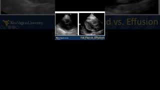 Pericardial Effusion vs Fat Pad emergencymedicine POCUS echo echofirst FOAMed FOAMus [upl. by Omle862]