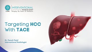 HCC Liver Cancer Understanding Treatment and TACE in English [upl. by Tudor682]