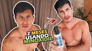 MINOXIDIL 2 meses usando [upl. by Greer]