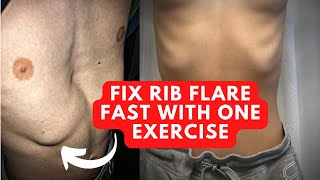 How To Fix Rib Flare With This 1 Powerful Exercise [upl. by Pangaro]