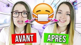 AVOIR UN APPAREIL DENTAIRE  AVANT VS APRES [upl. by Nyleaj]