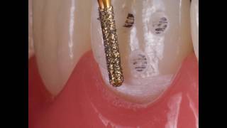 Minimally Invasive Ceramic Restorations [upl. by Lavina]