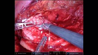 Robotic Nephron Sparing Surgery for Large Endophytic Renal Mass [upl. by Takeo]