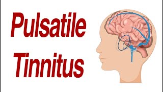 Pulsatile Tinnitus 7 Different Anatomic Causes of Hearing Pulsations in the Ear [upl. by Acimak]