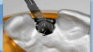 CAMLOG Implant Placement  Part 2  Healing and Prosthetics [upl. by Batory]