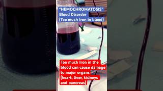 EXCESSIVE IRON in BLOOD VERY DANGEROUS Hemochromatosis shorts short family [upl. by Pegg]