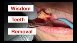 Wisdom Teeth Removal [upl. by Damita]