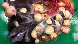 Hydatid cyst liver cyst due to Echinococcus infection [upl. by Dare]