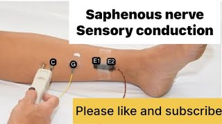 SAPHENOUS NERVE sensory nerve NCS neurology neurotech [upl. by Bever450]