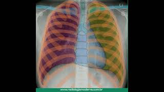 Tórax Anatomia radiográfica básica [upl. by Mitman]