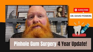 Pinhole Gum Surgery 4 Year Update [upl. by Moth928]