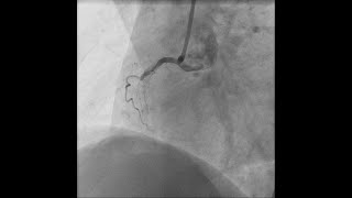 CTO intervention second attempt is different [upl. by Derina]