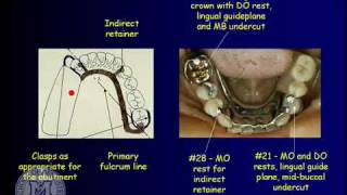 DENT 718 Removable partial dentures design considerations [upl. by Rolecnahc]