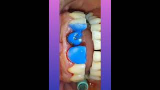 stepsprocedureremoval of old ill fitted crown worn for decades converted to total buildupcosmetic [upl. by Ertnom]