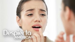 Remedios caseros para aliviar el herpes labial [upl. by Anaujit]