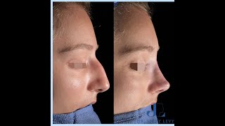 Rhinoplastie ultrasonique à Paris [upl. by Enimajneb]