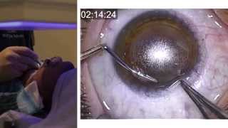 London Vision Clinic  ReLEx SMILE  Live laser eye surgery  Professor Dan Reinstein [upl. by Jobyna]