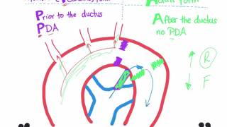 Coarctation of aorta Infantile type vs adult type mnemonic [upl. by Charlton392]