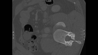 Thoracolumbar reconstruction of L1L2 fracture dislocation with lateral listhesis [upl. by Hammerskjold]