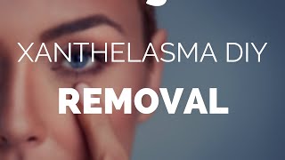 Xanthelasma diy removal easy home removal with Xanthel [upl. by Ingmar503]