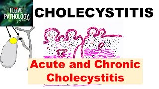 CHOLECYSTITIS Acute and Chronic Pathology and Complications [upl. by Alya]