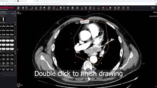 MedDream DICOM Viewer mark and store the ROI region of interest [upl. by Crispas653]