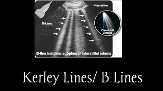 Kerley Lines  B Lines [upl. by Harutek]