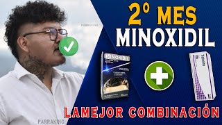 Minoxidil con Tretinoina la mejor opción para lampiños  2 meses con Minoxidil [upl. by Sande51]