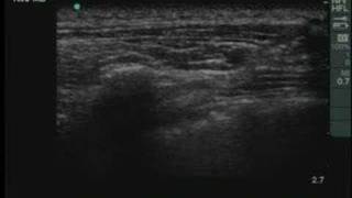 UltrasoundGuided Thoracic Paravertebral Block [upl. by Bartlett164]