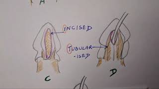 Hypospadias  TIP [upl. by Nevear]