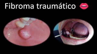 👄 Fibroma traumático oral  Cavidad oral  Cabeza y Cuello  Patología [upl. by Narud]