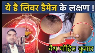 लीवर डैमेज का स्किन symptoms Acanthosis Nigricans Kya hota hai ये है लिवर डैमेज के लक्षणhealthtips [upl. by Aikkin398]