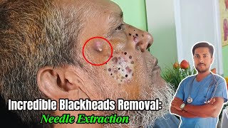 7YearOld Giant Blackhead Extraction Needle Method Revealed  alliedhealthscience skincare [upl. by Pas543]