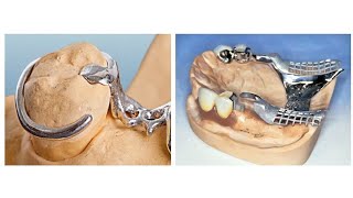 Prosthodontics Practical  Third Stage  The Clasp [upl. by Liahus715]