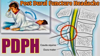 Post Dural Functure Headache  PDPH  Mechanism of PDPH [upl. by Kaz904]