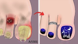 ASMR Ingrown toenail removal treatment animation  Satisfying nail art [upl. by Stelmach639]