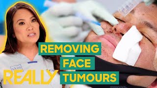 Dr Lee’s Patient Endures Uncomfortable Face Tumour Removal  Dr Pimple Popper Pop Ups [upl. by Ueih621]