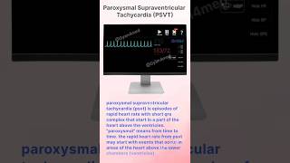 Paroxysmal Supraventricular Tachycardia PSVT [upl. by Hajan691]