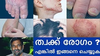 Psoriasis  Skin diseases treatment  Mohanan Vaidyar [upl. by Terrene]