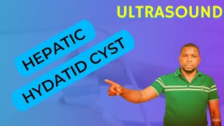 Ultrasound Video showing Hepatic hydatid cyst [upl. by Resay685]