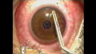 Lasik Laser Eye Surgery Procedure  Live Surgery [upl. by Anawk]