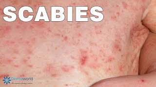 What are Scabies How are they caused How to Cure them [upl. by Martinsen714]