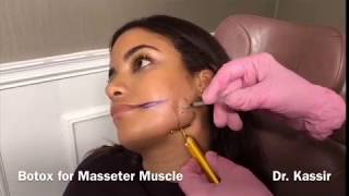 Botox for Masseter Muscle [upl. by Aisenat993]