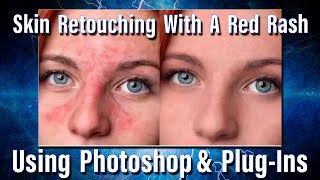 Retouching skin with a bad rash in Adobe Photoshop [upl. by Paryavi974]