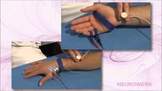 Sensory Neurography  Median Nerve [upl. by Cade]