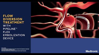 Flow Diversion Treatment with Pipeline Flex Embolization Device  Medtronic India [upl. by Aivatnahs]