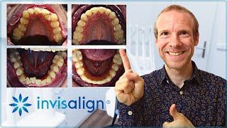 ⚡ Mi EXPERIENCIA con INVISALIGN 😃 siendo ACTOR 💯 Mi DENTISTA y yo ACLARAMOS TUS DUDAS [upl. by Yvonne]