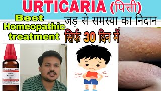 URTICARIAपित्ती Best homeopathic medicine for urticaria खुजली को कहो अलविदा urticaria treatment [upl. by Dailey]