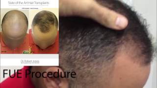 FUE Hair Transplant  3000 Grafts  Dr Rob Jones  Toronto CA Hair Transplant Doctor [upl. by Prussian230]